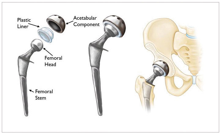 Hip replacement diagram 1