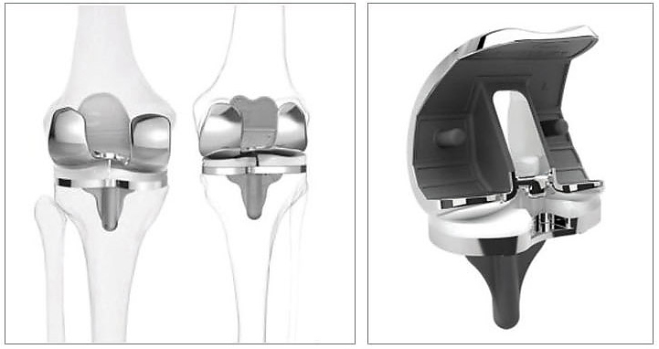 Knee replacement diagram 1