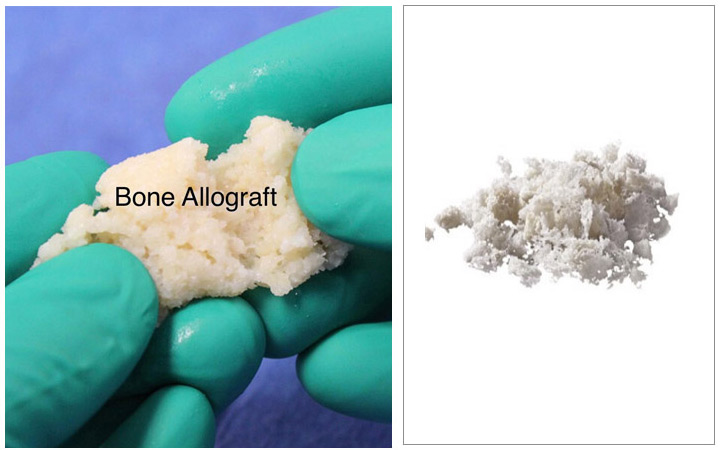 Orthobiologics diagram 1