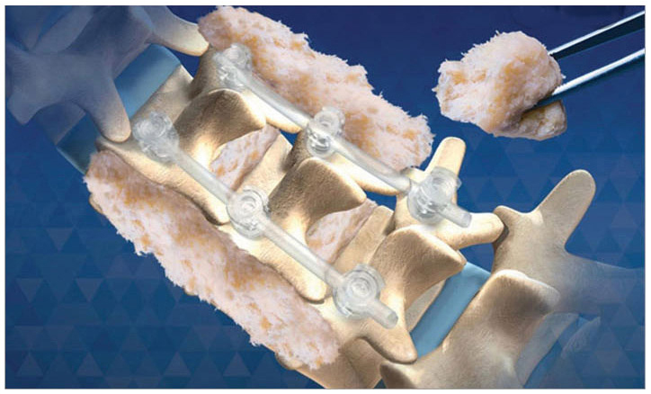 Spine surgery diagram 1