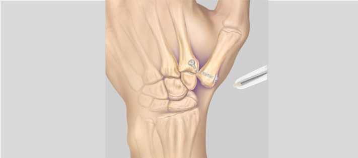 Upper extremity diagram 1
